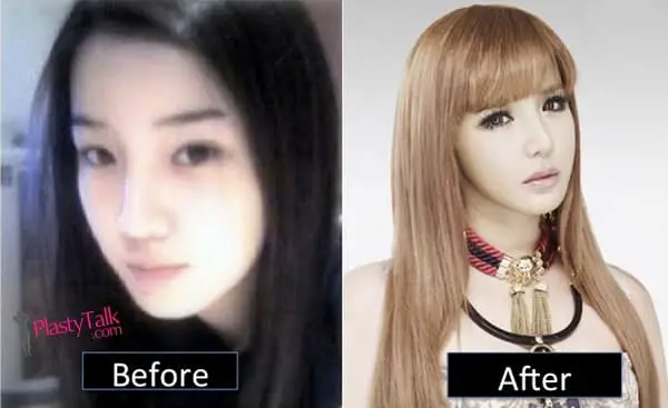 Before Plastic Surgery And After Park Bom 1