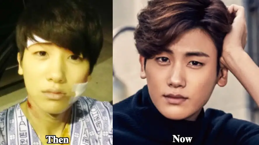 Park Hyung Sik Plastic Surgery Before And After photo - 1